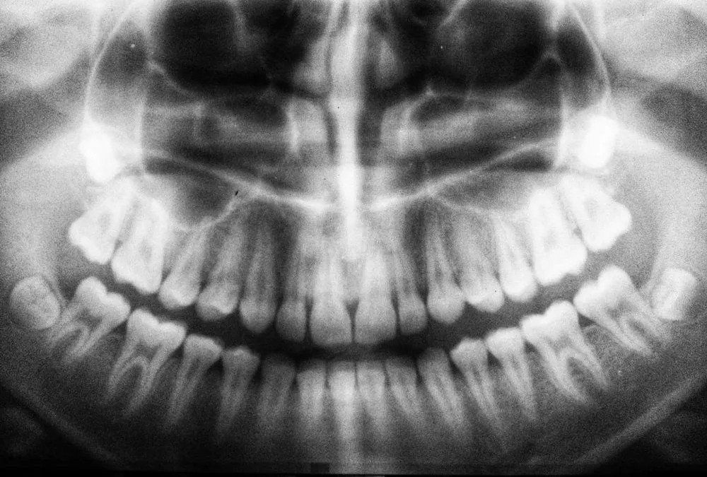 cavity
